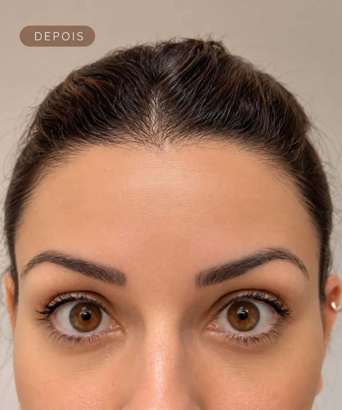 Depois — Aplicação de Botox