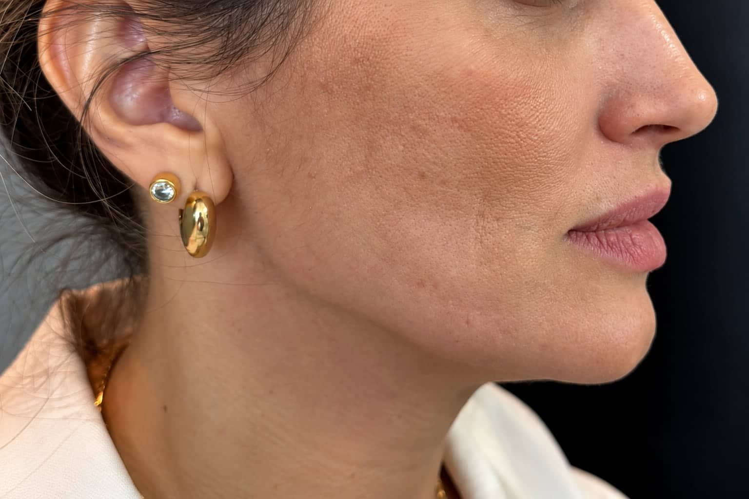 Antes — Contorno facial