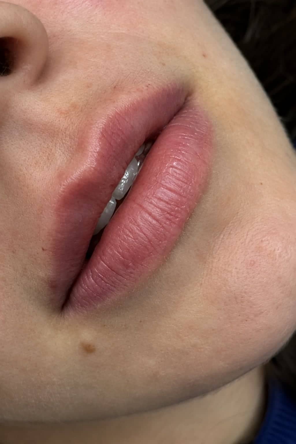 Antes — Preenchimento labial